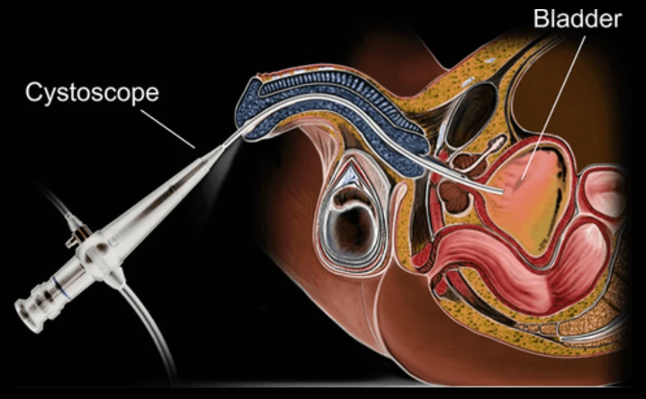 Melbourne Flexible Cystoscopy Urologist