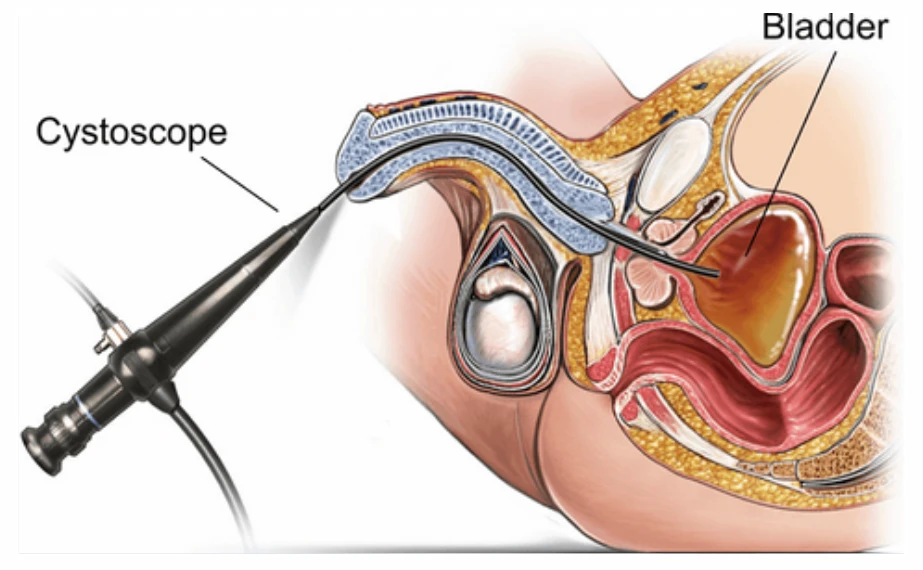 Melbourne Flexible Cystoscopy Urologist