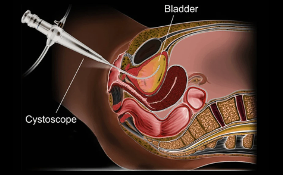 Melbourne Flexible Cystoscopy Urologist