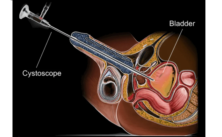 Melbourne Cystoscopy Urologist