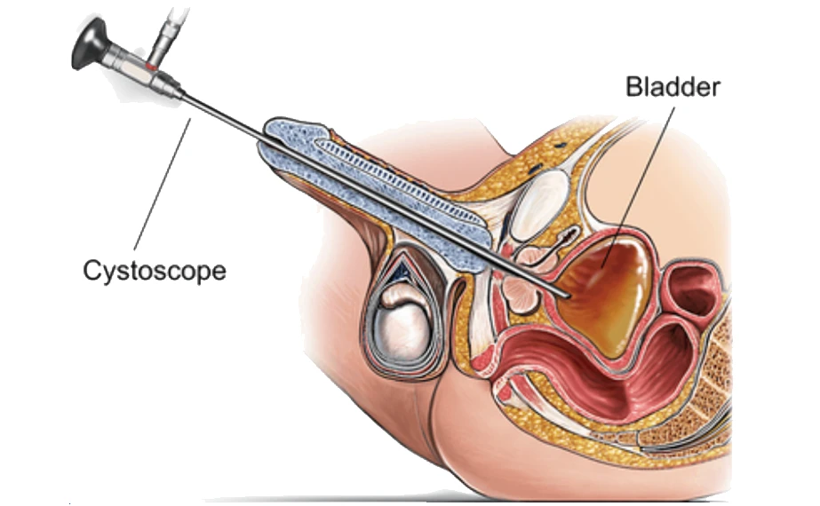 Melbourne Cystoscopy Urologist