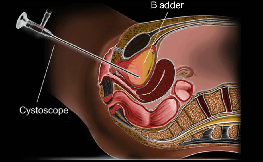 Melbourne Cystoscopy Urologist