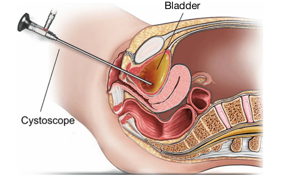 Melbourne Cystoscopy Urologist