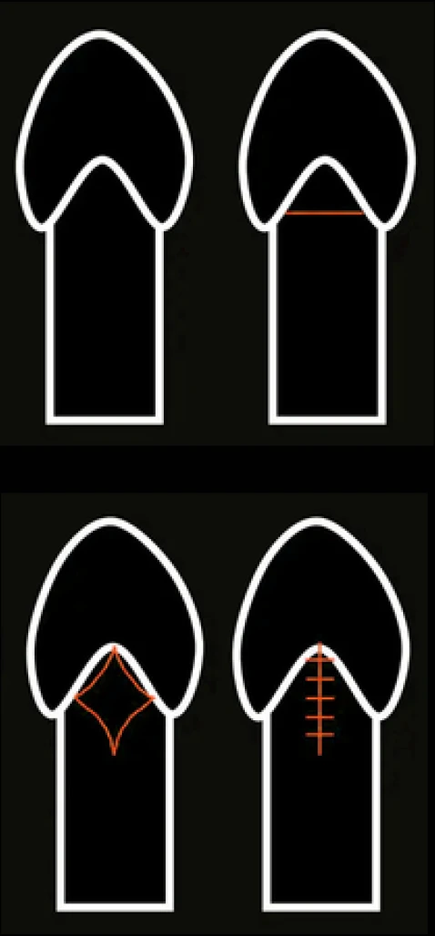 Diagram of frenuloplasty stitches
