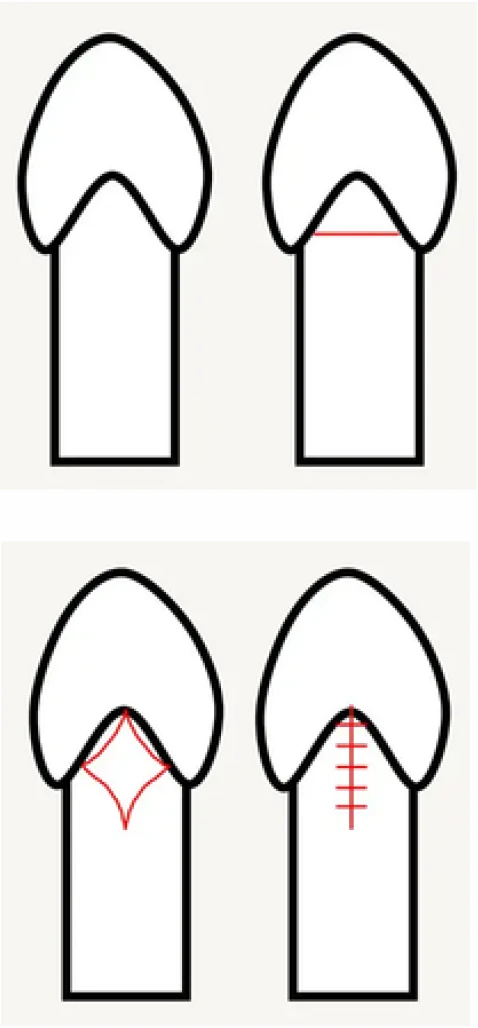 Diagram of frenuloplasty stitches