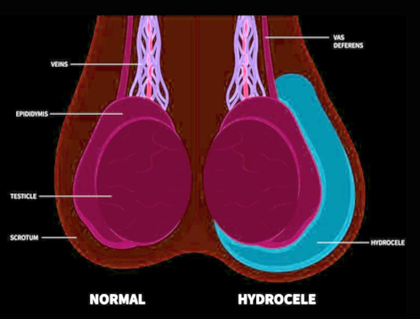 Melbourne Hydrocoele Surgery Urologist