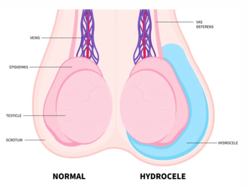 Melbourne Hydrocoele Surgery Urologist