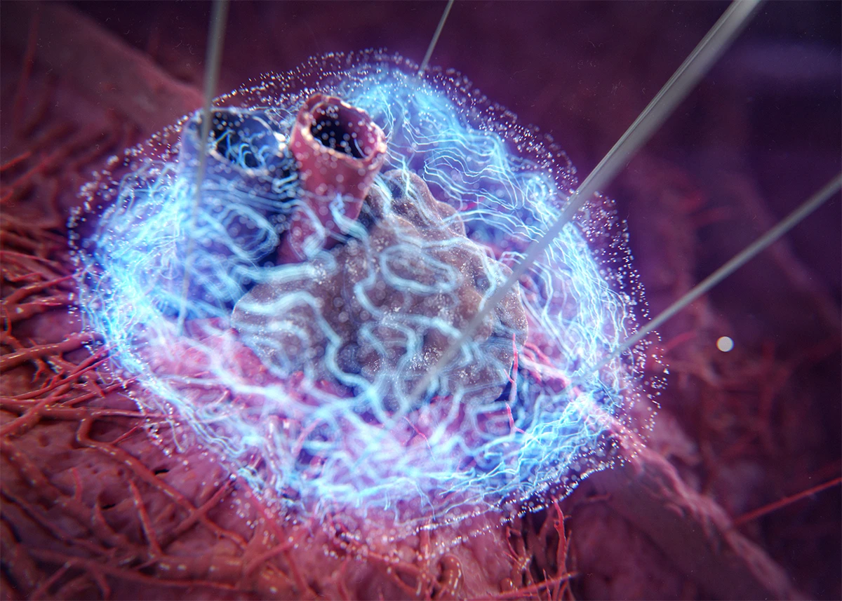 Focal Therapy with NanoKnife for prostate cancer