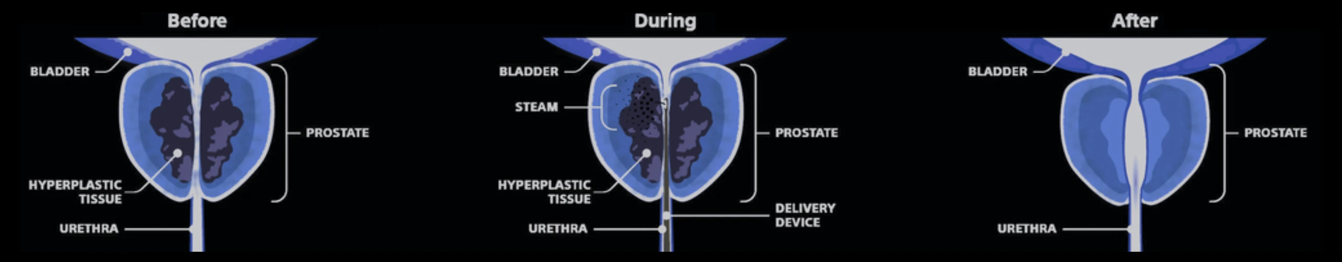Melbourne Rezum Treatment for benign prostatic hyperplasia