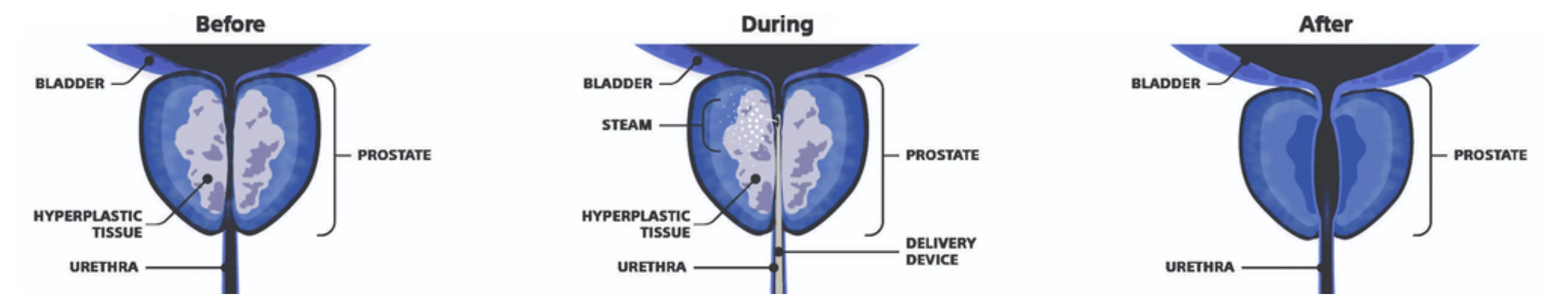 Melbourne Rezum Treatment for benign prostatic hyperplasia