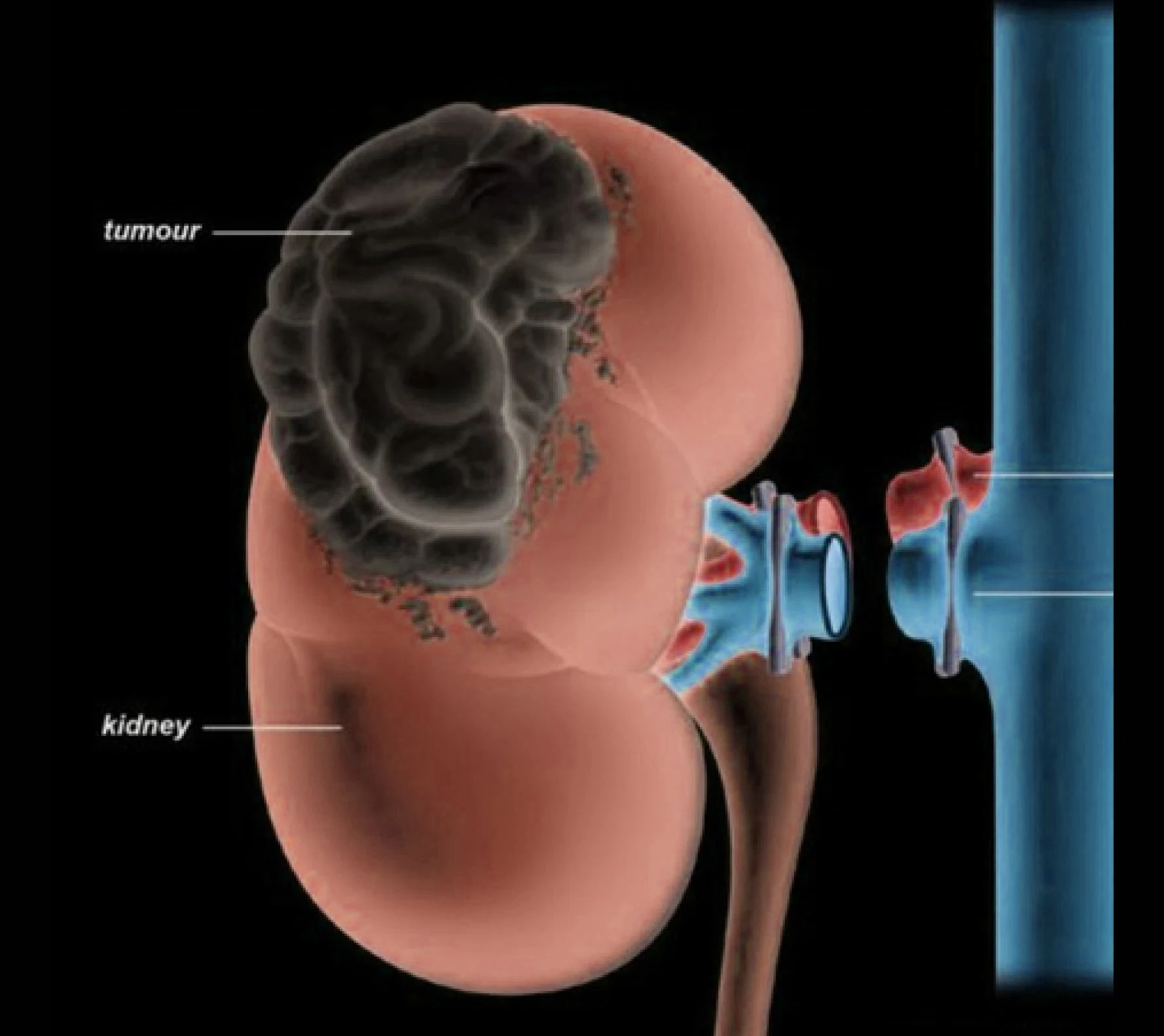 Radical nephrectomy