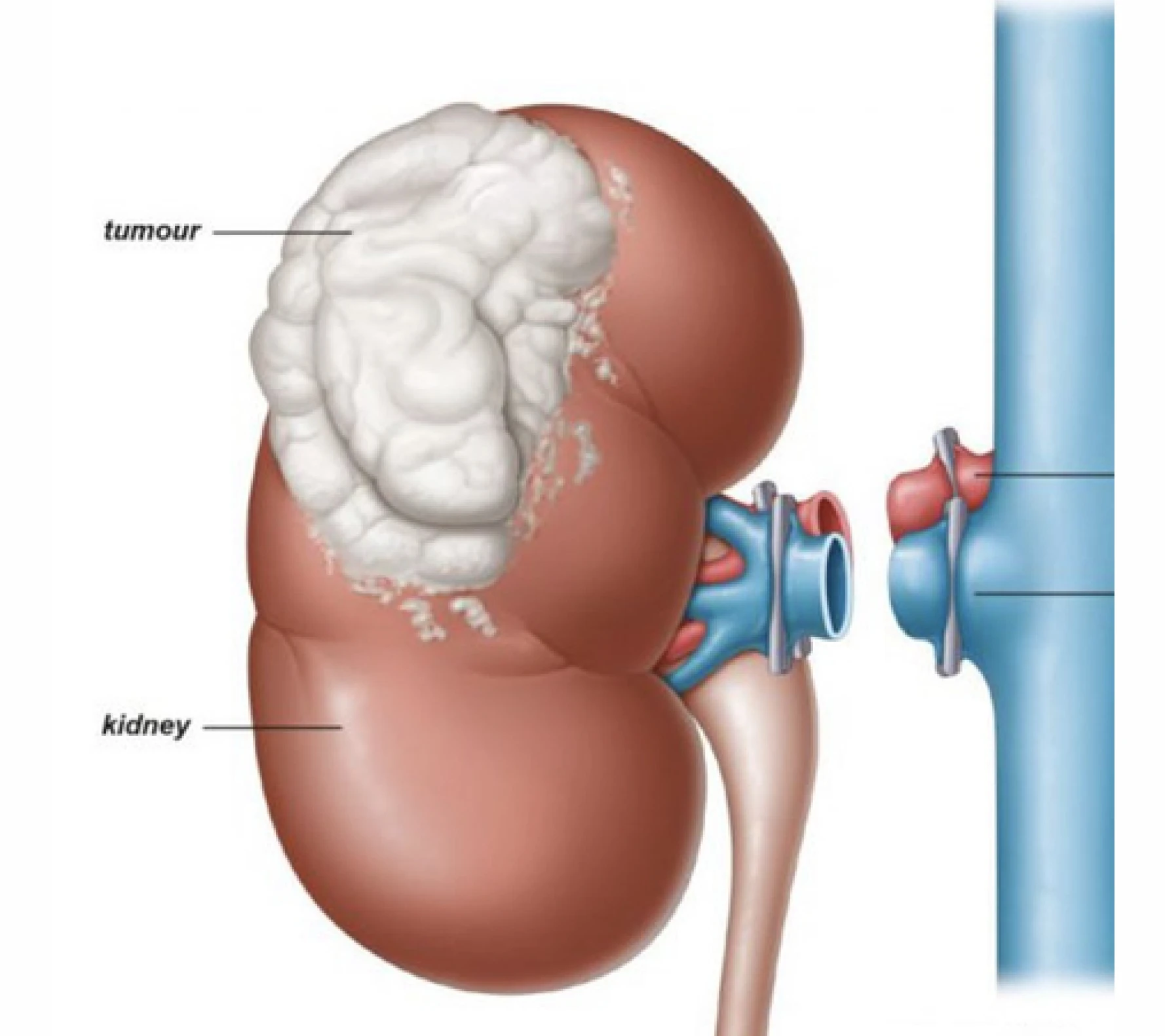Radical nephrectomy