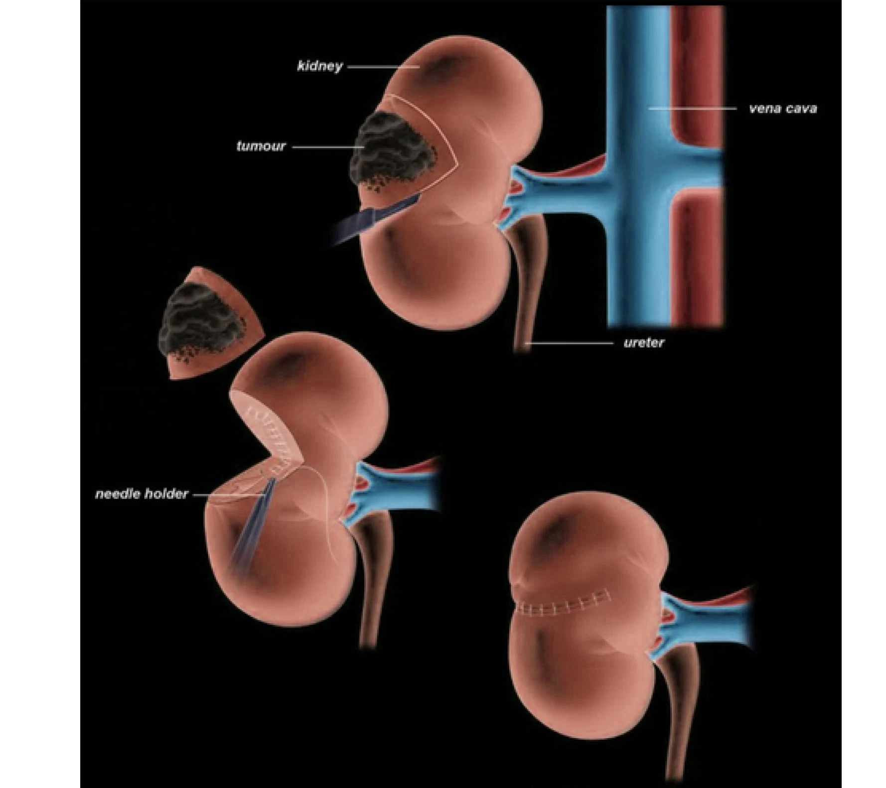 Robotic Assisted Partial/Radical Nephrectomy