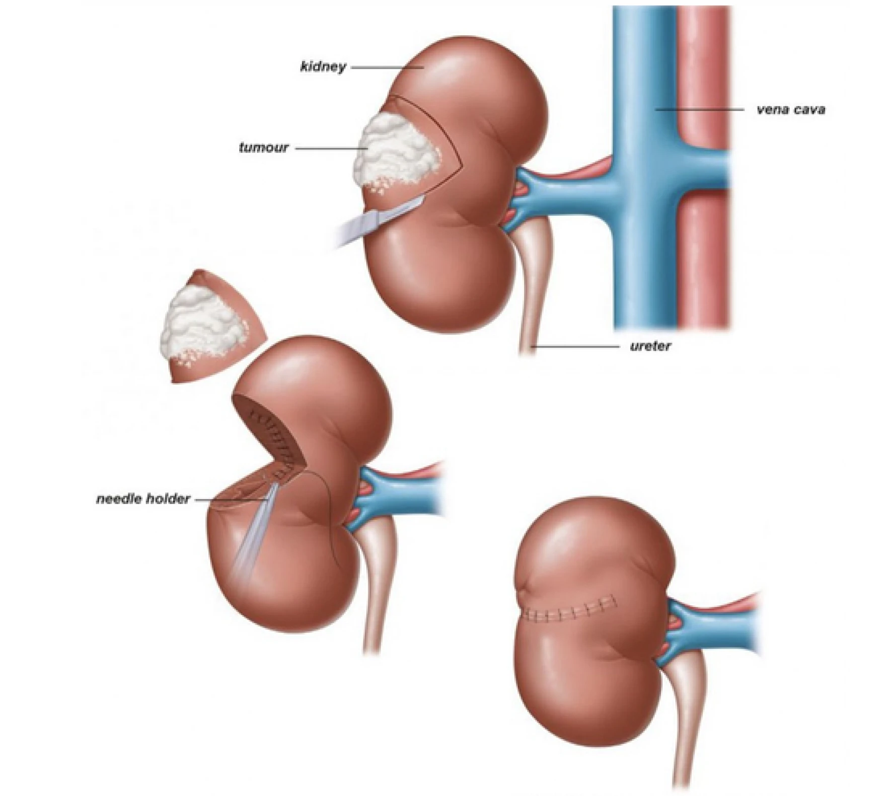 Robotic Assisted Partial/Radical Nephrectomy