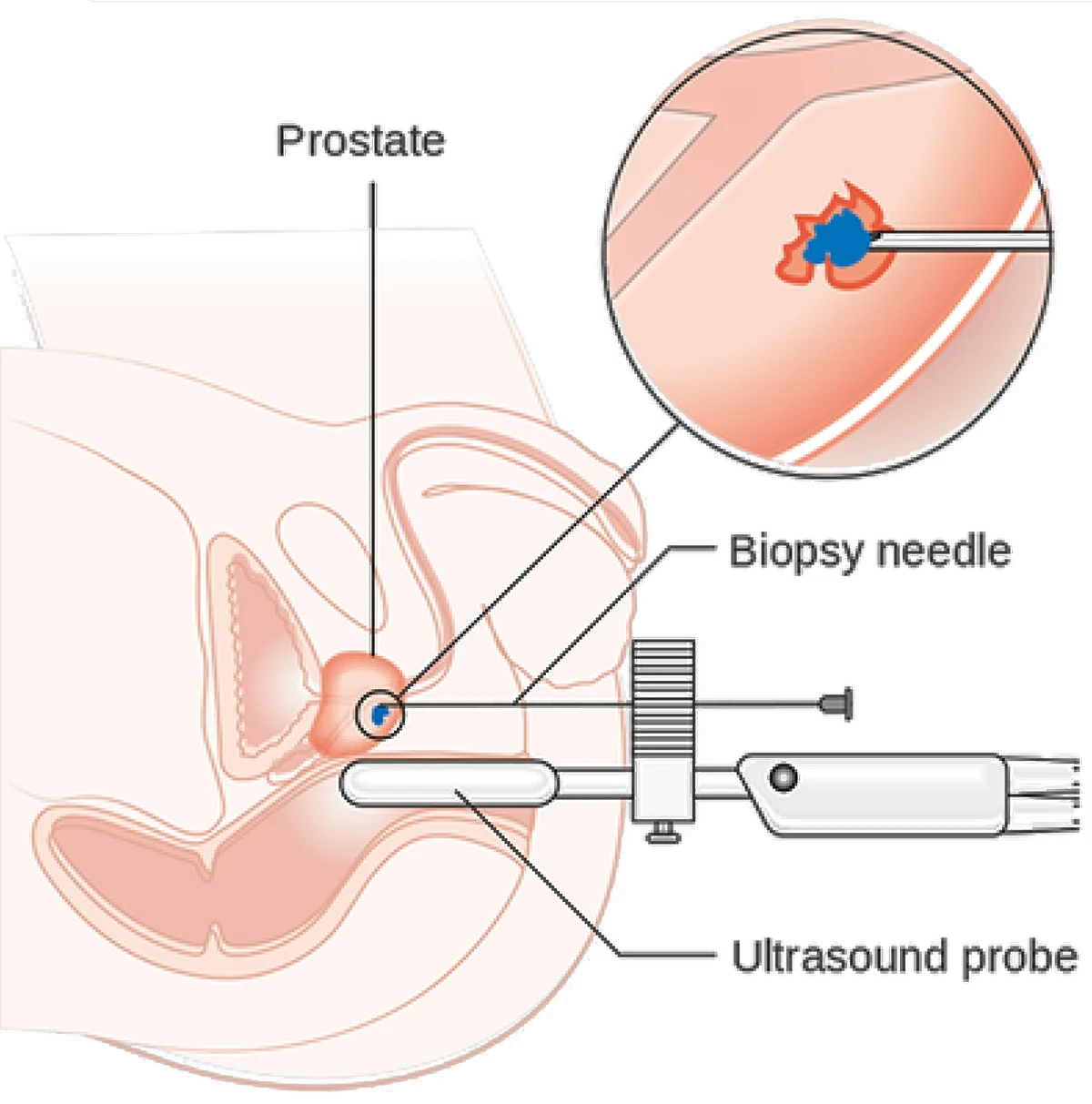 Diagram of Transperineal Prostate Biopsy
