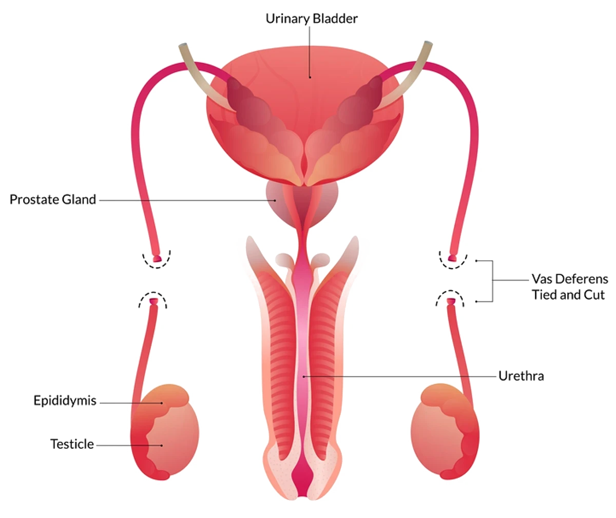 Melbourne Vasectomy Urologist
